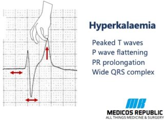 Hyperkalemia Ecg Changes Mnemonic With Ecg Strips