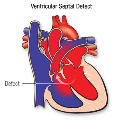 Tetralogy of Fallot Mnemonic [High-yield & Easy-to-Remember]