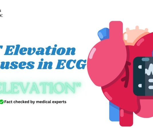 ST Elevation Causes in ECG Mnemonic